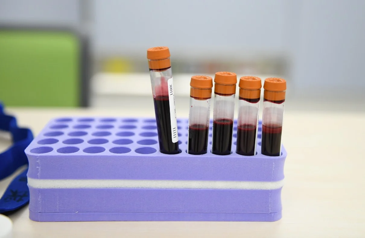 Alzheimer's Blood Test That Can Detect The Disease Before Symptoms