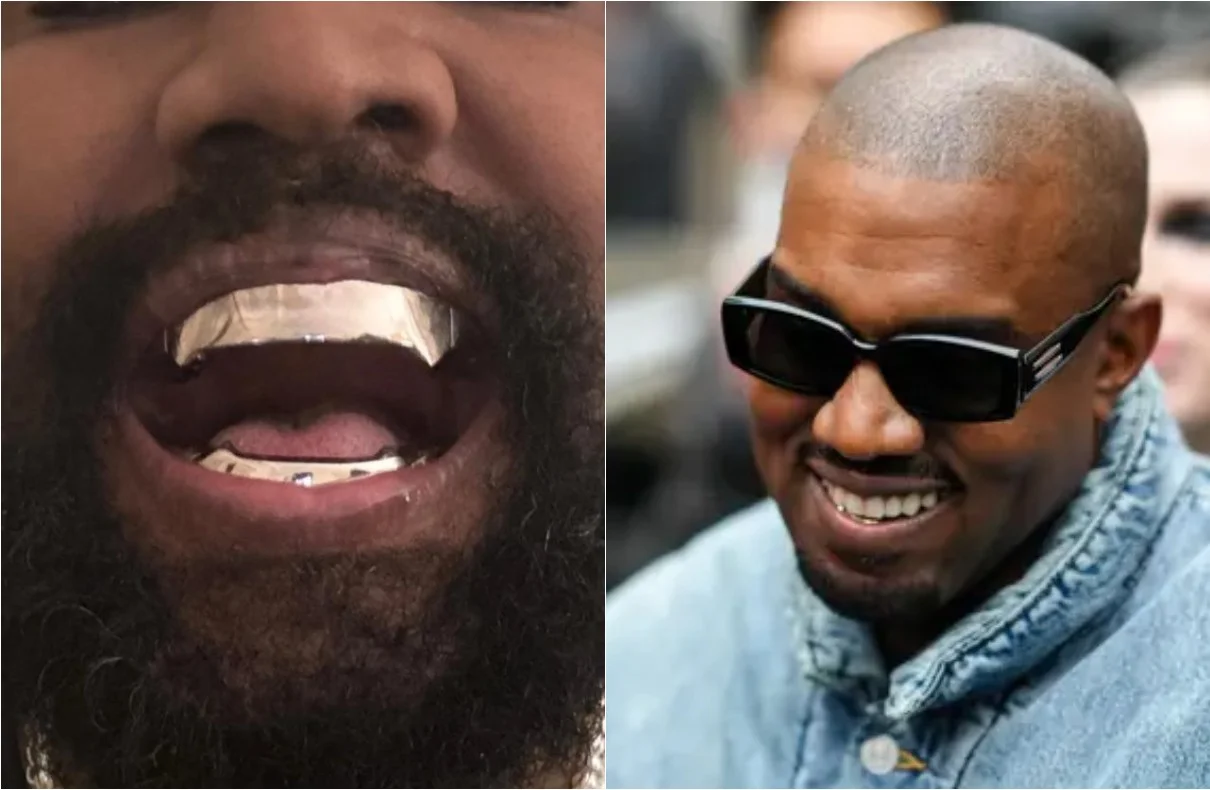 Kanye West's Epic Dental Makeover With Titanium Dentures