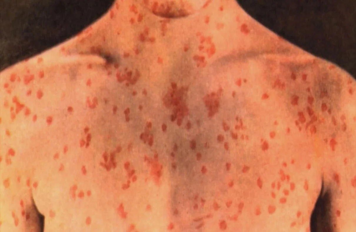 First Reported Incident of Measles in Lake County
