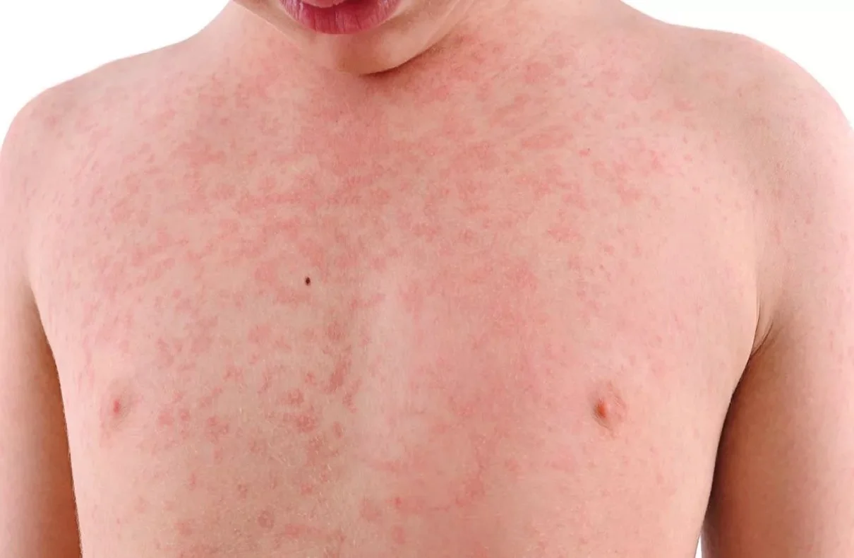 Measles Alert In Washtenaw And Wayne Counties A Comprehensive Analysis