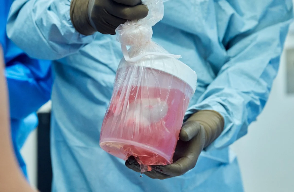 The First Successful Pig Kidney Transplant in a Human Recipient