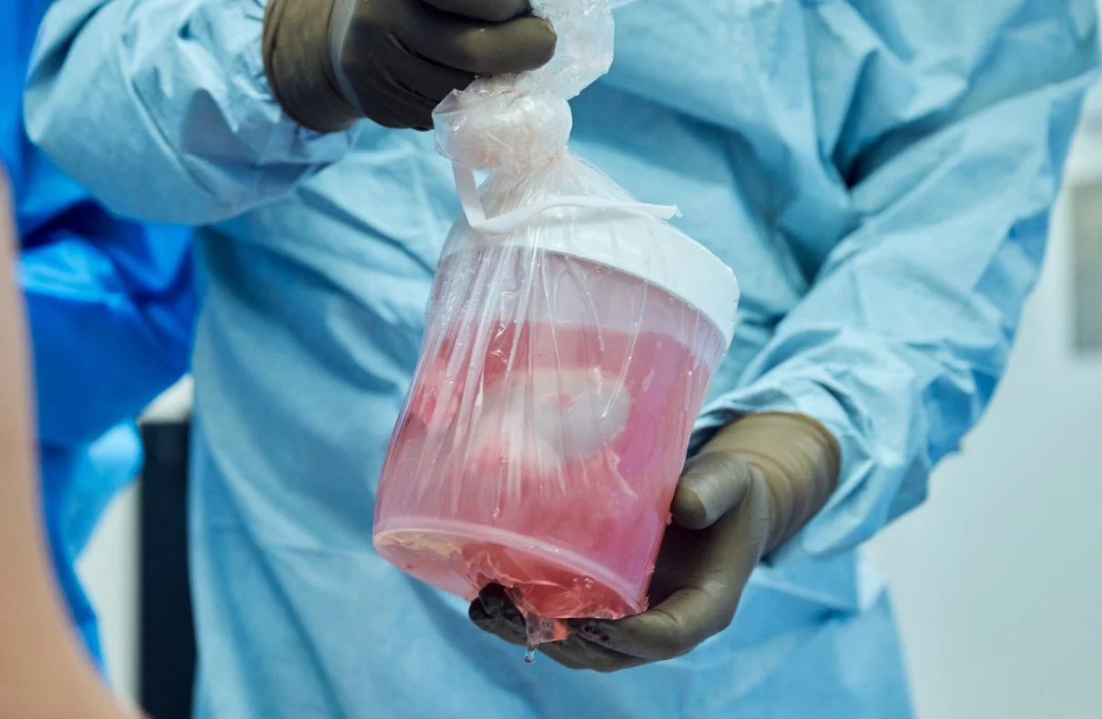 The First Successful Pig Kidney Transplant In A Human Recipient